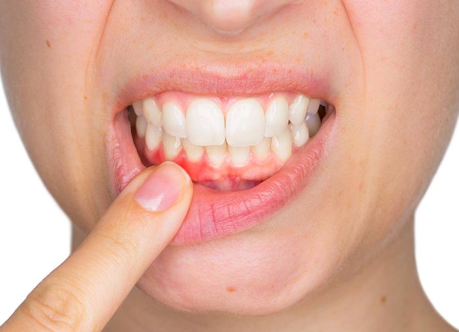 Bleeding Gums