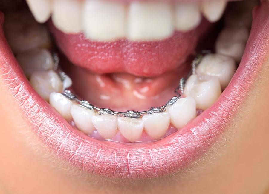 Wire on Back of Teeth