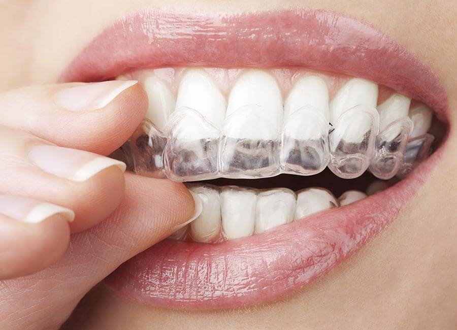 Veneers
