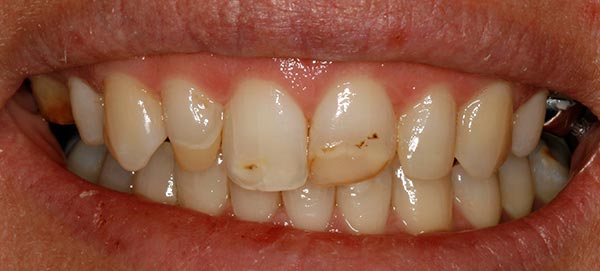 Teeth Decay