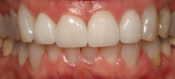 Straight White Teeth