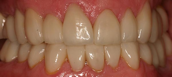 Straight Teeth After Veneers