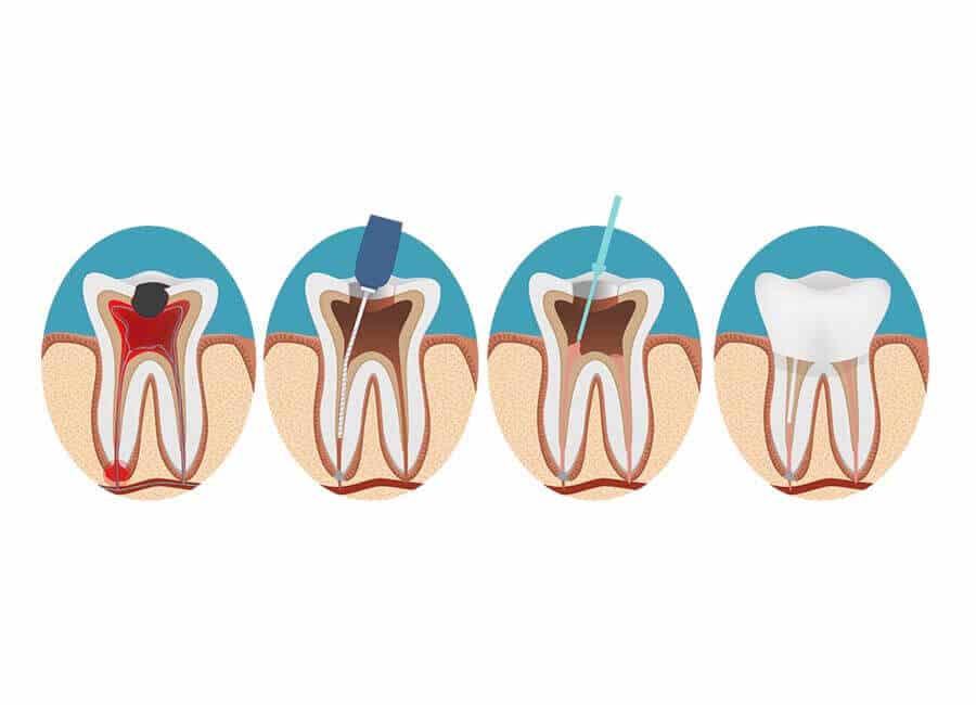 Root Canal Process cheltenham geotagged